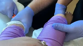 Cerebral Palsy Storm May Need Surgery (AFO Fitting)