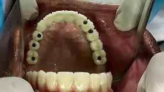 FULL MOUTH REHABILITATION (FMR)