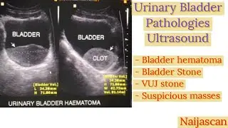 Abdominal Scan Unveils Bladder Abnormalities: Stones, Hematomas, and More