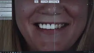 Digital Smile Design или технология &laquo;Цифровой дизайн улыбки&raquo;