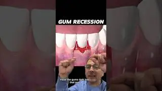 An Invasive Way to Fix Gum Recession | View Mobile Dental #shorts