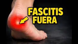 Tu fascitis plantar desaparecer&aacute; con esto