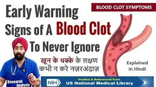 Never Ignore these Symptoms - Early Warning signs of a Blood Clot | Dr.Education (Hindi)
