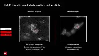 Identifying Disease Signatures In Situ Using Highly Sensitive Spatial Transcriptomics