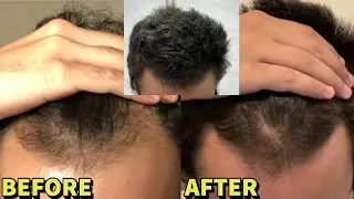 He REVERSED Hair Loss With JUST Dutasteride and Microneedling! UNBELIEVABLE RESULTS!