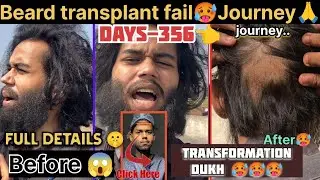 Days-356 Beard Transplant Fail😱🔥|| Result Condition Journey 🙏