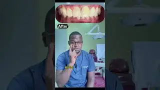 Fractured tooth replacement #dentist #tooth #toothreplacement #Dentistry #Dentalcrown
