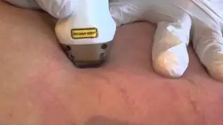 Furrow Fractionele Laser