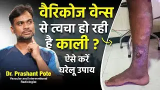 Easy Home Remedies for Skin Discoloration Caused by Varicose Veins | Dr. Prashant Pote