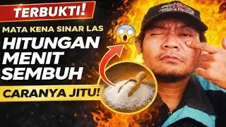 Solusi atasi mata yang kena sinar las hitungan menit bisa sembuh 