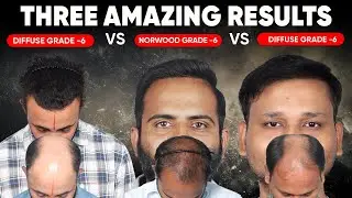 Best Hair Transplant in Tirupati (HX-DSAW) | Best Results & Cost of Hair Transplant in Tirupati.