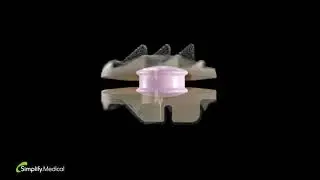 Simplify Medical: Simplify Disc in Motion