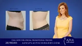 Abdominoplasty with Liposuction at Azul Plastic Surgery Sugar Land Houston TX