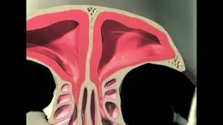 Balloon Sinuplasty Animated Procedure Video