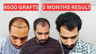 5 MONTHS Result after HAIR TRANSPLANT | 4500 GRAFTS , FUE , SAPPHIRE BLADE  HAIR TRANSPLANT RESULT