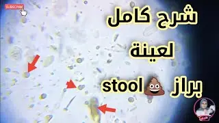 شرح فحص عينة براز بها حويصلات cysts in stool sample