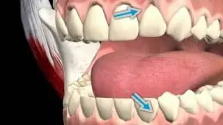 Marginal Gums (Gingiva Fixa)