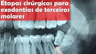 Etapas cirurgicas para exodontias de terceiros molares | Odontologia | Dra Bianca Rosa