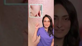 Open pores | how to treat | what to do & what to avoid