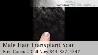 Male Hair Transplant Scar After 4.5 Months  - Natural Transplants | Dr. Kevin Blumenthal (Anonymous)