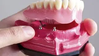 FAQ Benefits of implant retained dentures
