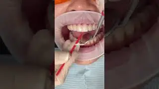 Porcelain veneers procedure | porcelain veneers before and after | Dr. Yazdan #veneers #dentist