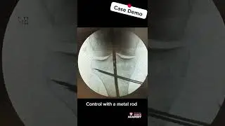 Overcorrection of a medial open wedge high tibial #osteotomy  💥 #orthopedics #knee #kneesurgey