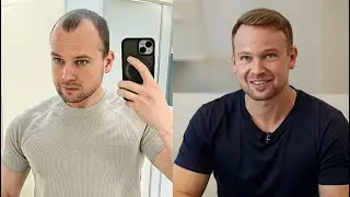 8 Monate nach meiner Haartransplantation - Natürliches Ergebnis?