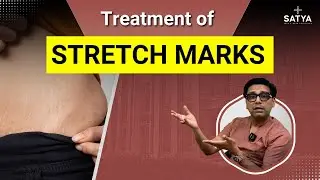 Stretch Marks Treatment | How to Remove Stretch Marks at Home| Best Stretch Marks Treatment | Satya