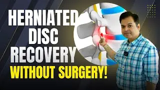 Disc Bulge Treatment, L4-L5, L5-S1, Lumbar Canal Stenosis, Herniated Disc Recovery without Surgery