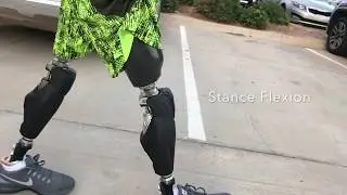 Bilateral Above Knee Prosthetic Users