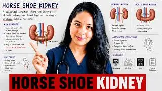 horseshoe kidney |Dr. Shipra Mishra|