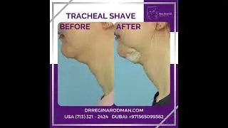Tracheal Shave