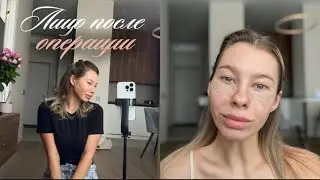 Сняла пластыри после блефаропластики. Впервые показываю себя без отёков. Лицо ДО и ПОСЛЕ операции