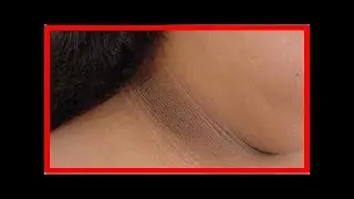 4 mani&egrave;res d&rsquo;att&eacute;nuer la peau noircie du cou