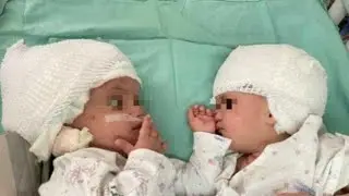 Israele, il primo sguardo tra le gemelline separate dopo 12 ore di operazione