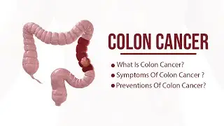 What is Colon Cancer? | What is Colon Cancer? | Symptoms of Prevention of Colon Cancer