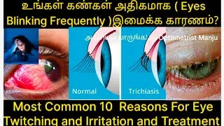 Why Eyes is Blinking Continuously or Frequently 10 Reasons in Tamil |கண்கள் அதிகமாக இமைக்க காரணம்