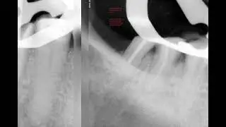 Retreatment and management of transportation of mesial canal with mta wrt 46😊🥰🙏