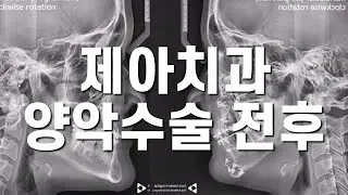 제아치과 양악수술 전후 / zeah dental cephalometry superimposition before and after two jaw surgery
