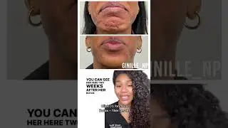 Before and after Botox for chin dimpling, pebbled chin, skin tightening, chin filler effect