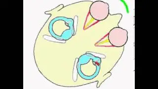 Right Horizontal Cupulolithiasis Pathophysiology