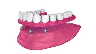 Implant Types for Dentures | Capron Park Dental
