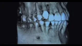 Dental Implant Reconstruction with Oral Surgeon Dr. John Wallace