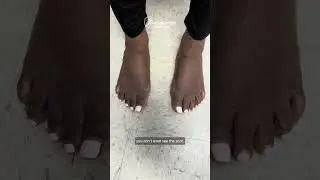 6 Weeks Post-Op Before & After: Minimally Invasive Bilateral Bunion Surgery | Dr. Justin Kane