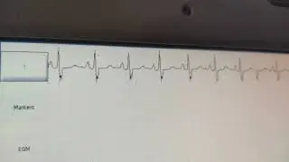 Ecg