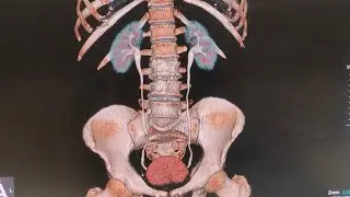 CT Urography Filming 
