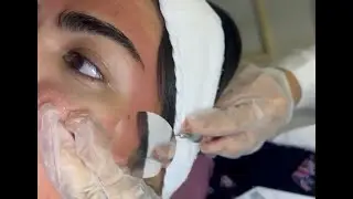 Subcision for Acne Scars | Best Acne Scar Treatment | Philippines