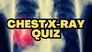 Chest X-ray Quiz