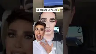 James Charles confirms having lip fillers